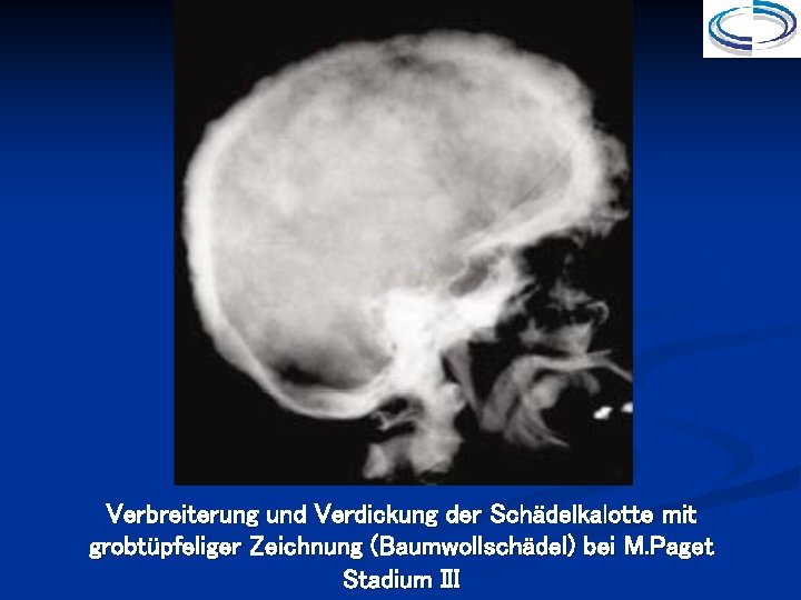 Verbreiterung und Verdickung der Schädelkalotte mit grobtüpfeliger Zeichnung (Baumwollschädel) bei M. Paget Stadium III