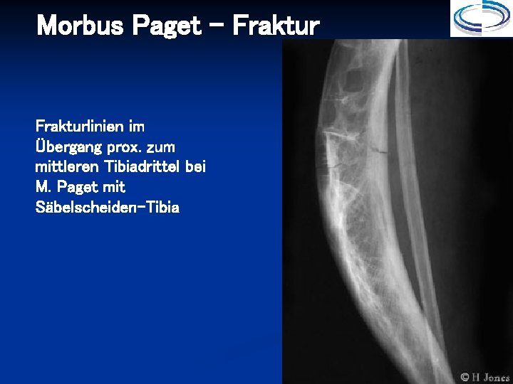 Morbus Paget - Frakturlinien im Übergang prox. zum mittleren Tibiadrittel bei M. Paget mit