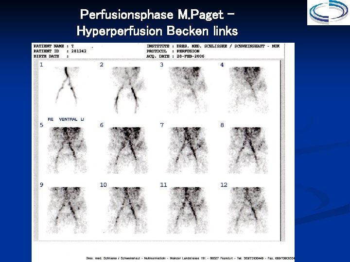 Perfusionsphase M. Paget – Hyperperfusion Becken links 
