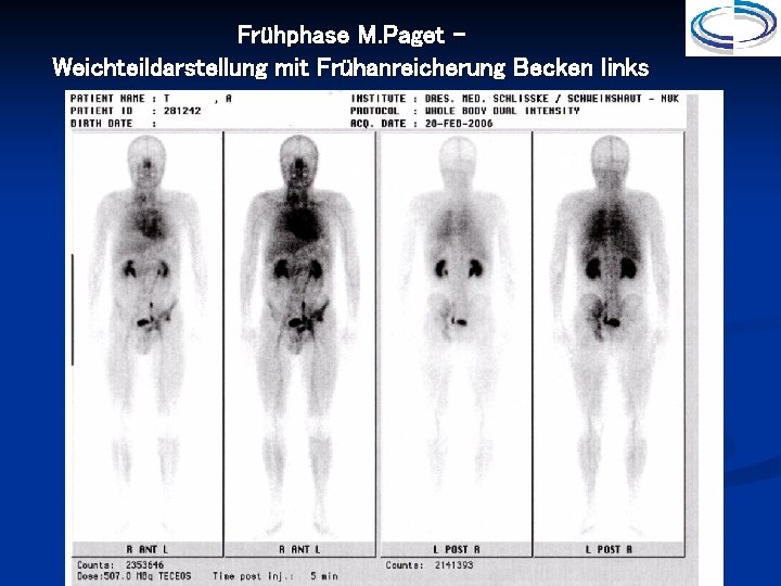 Frühphase M. Paget – Weichteildarstellung mit Frühanreicherung Becken links 