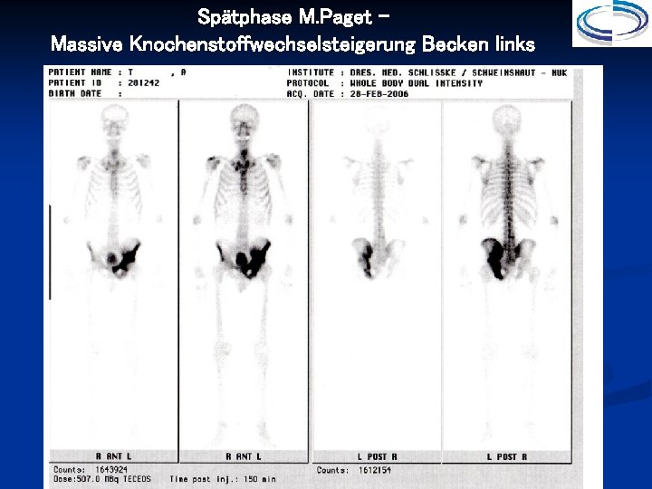 Spätphase M. Paget – Massive Knochenstoffwechselsteigerung Becken links 