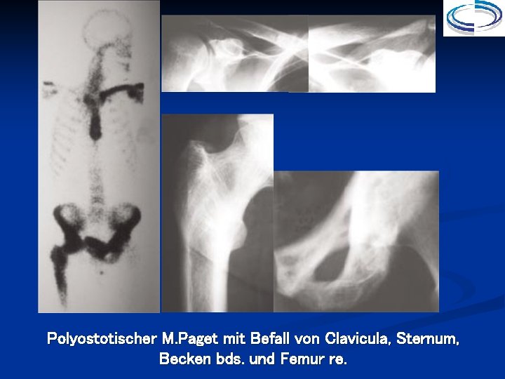 Polyostotischer M. Paget mit Befall von Clavicula, Sternum, Becken bds. und Femur re. 