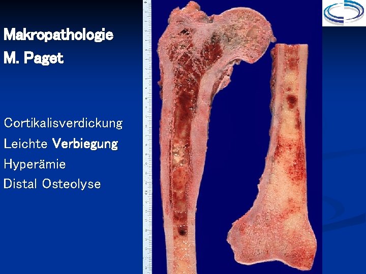 Makropathologie M. Paget Cortikalisverdickung Leichte Verbiegung Hyperämie Distal Osteolyse 