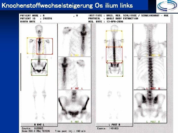 Knochenstoffwechselsteigerung Os ilium links 