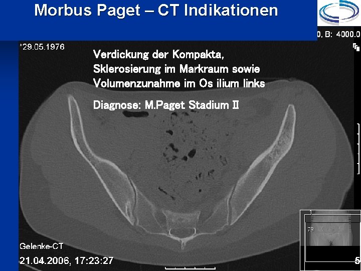 Morbus Paget – CT Indikationen Verdickung der Kompakta, Sklerosierung im Markraum sowie Volumenzunahme im