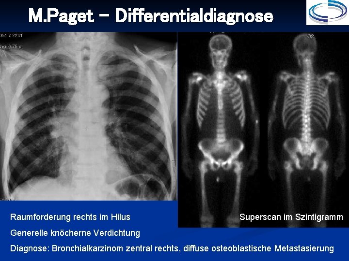 M. Paget - Differentialdiagnose Raumforderung rechts im Hilus Superscan im Szintigramm Generelle knöcherne Verdichtung