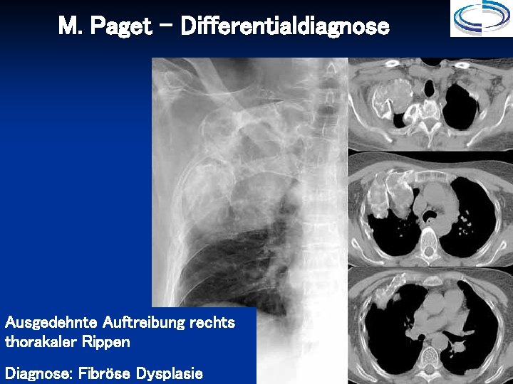 M. Paget - Differentialdiagnose Ausgedehnte Auftreibung rechts thorakaler Rippen Diagnose: Fibröse Dysplasie 