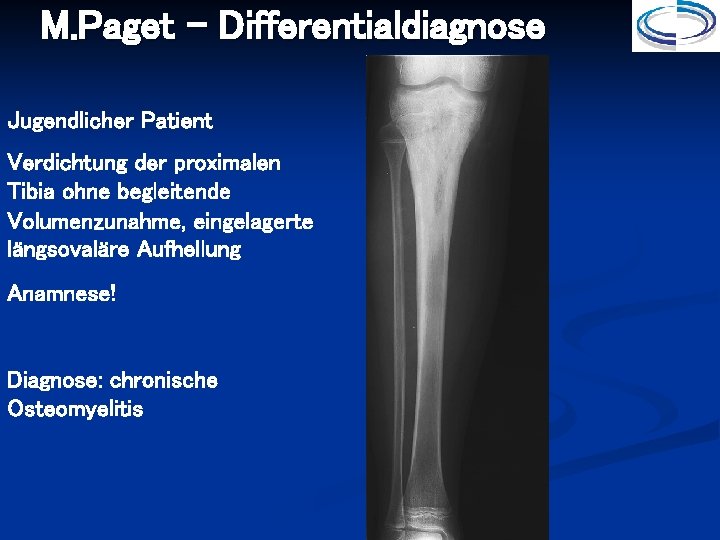 M. Paget - Differentialdiagnose Jugendlicher Patient Verdichtung der proximalen Tibia ohne begleitende Volumenzunahme, eingelagerte