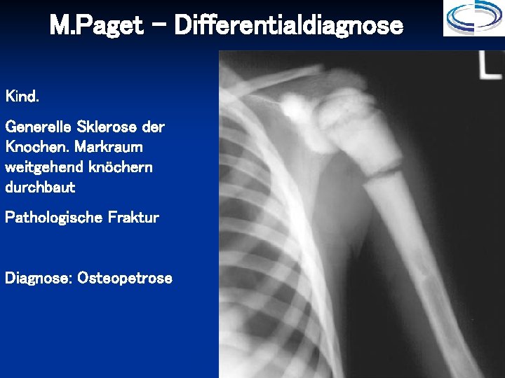 M. Paget - Differentialdiagnose Kind. Generelle Sklerose der Knochen. Markraum weitgehend knöchern durchbaut Pathologische