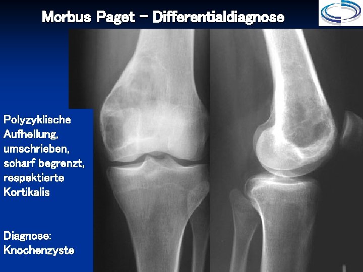 Morbus Paget - Differentialdiagnose Polyzyklische Aufhellung, umschrieben, scharf begrenzt, respektierte Kortikalis Diagnose: Knochenzyste 