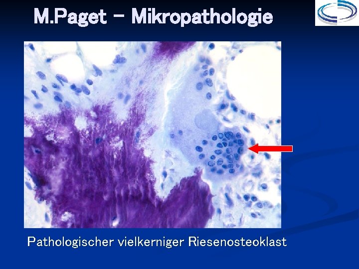M. Paget - Mikropathologie Pathologischer vielkerniger Riesenosteoklast 