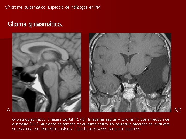 Síndrome quiasmático: Espectro de hallazgos en RM Glioma quiasmático. A B/C Glioma quiasmático. Imágen