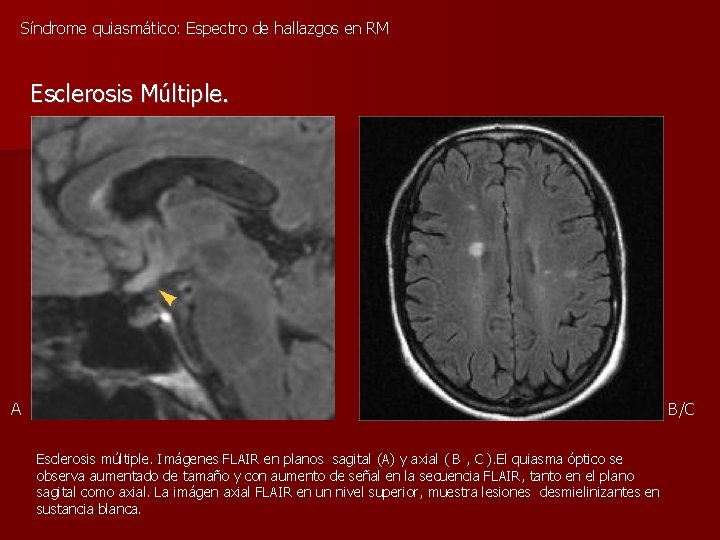 Síndrome quiasmático: Espectro de hallazgos en RM Esclerosis Múltiple. A B/C Esclerosis múltiple. Imágenes