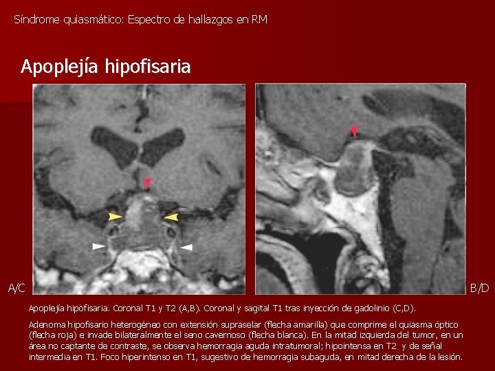 Síndrome quiasmático: Espectro de hallazgos en RM Apoplejía hipofisaria A/C B/D Apoplejía hipofisaria. Coronal