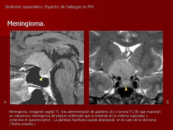 Síndrome quiasmático: Espectro de hallazgos en RM Meningioma. A B Meningioma. Imágenes sagital T