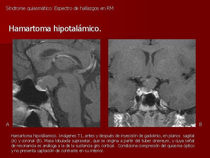 Síndrome quiasmático: Espectro de hallazgos en RM Hamartoma hipotalámico. A B Hamartoma hipotálamico. Imágenes