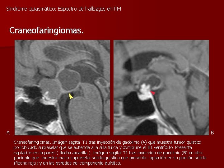 Síndrome quiasmático: Espectro de hallazgos en RM Craneofaringiomas. A B Craneofaringiomas. Imágen sagital T