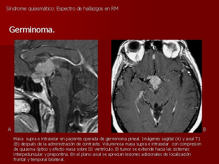 Síndrome quiasmático: Espectro de hallazgos en RM Germinoma. A B Masa supra e intraselar