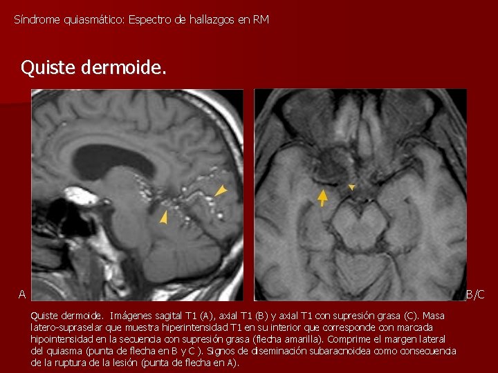 Síndrome quiasmático: Espectro de hallazgos en RM Quiste dermoide. A B/C Quiste dermoide. Imágenes