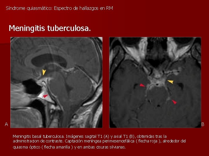 Síndrome quiasmático: Espectro de hallazgos en RM Meningitis tuberculosa. A B Meningitis basal tuberculosa.