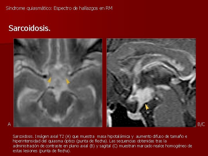 Síndrome quiasmático: Espectro de hallazgos en RM Sarcoidosis. A B/C Sarcoidosis. Imágen axial T