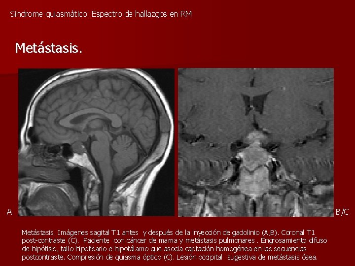 Síndrome quiasmático: Espectro de hallazgos en RM Metástasis. A B/C Metástasis. Imágenes sagital T