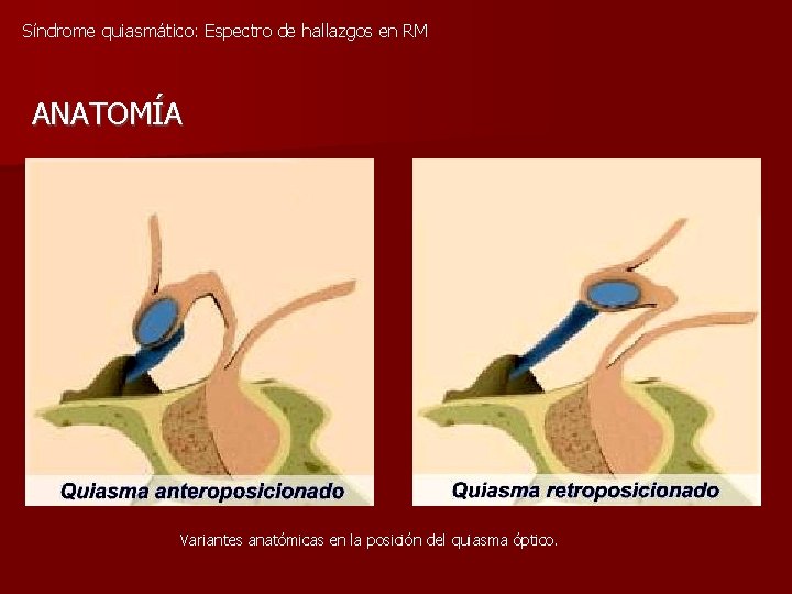 Síndrome quiasmático: Espectro de hallazgos en RM ANATOMÍA Variantes anatómicas en la posición del