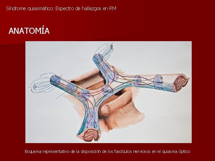 Síndrome quiasmático: Espectro de hallazgos en RM ANATOMÍA Esquema representativo de la disposición de