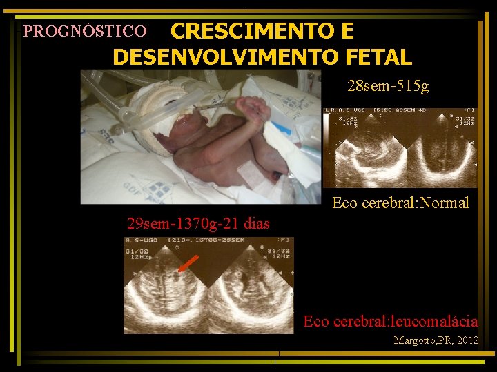 CRESCIMENTO E DESENVOLVIMENTO FETAL PROGNÓSTICO 28 sem-515 g Eco cerebral: Normal 29 sem-1370 g-21