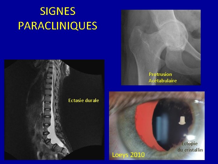 SIGNES PARACLINIQUES Protrusion Acétabulaire Ectasie durale Loeys 2010 Ectopie du cristallin 