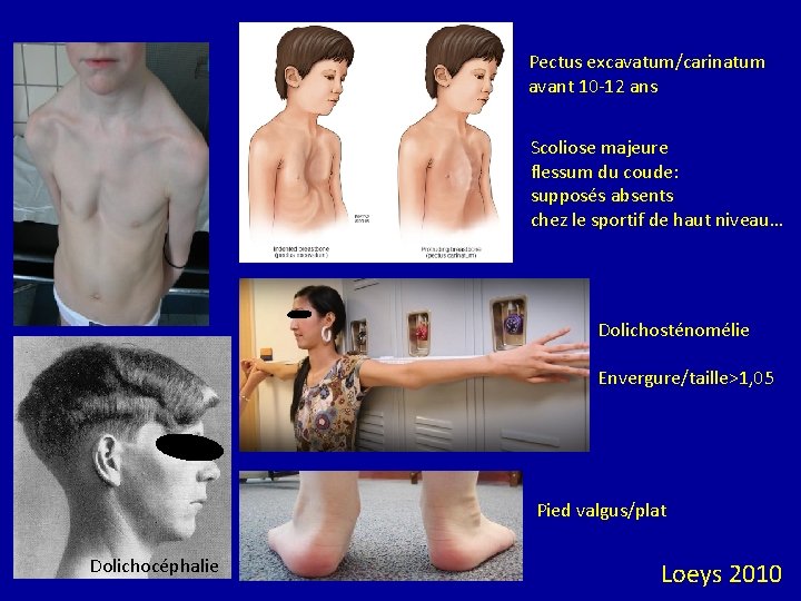 Pectus excavatum/carinatum avant 10 -12 ans Scoliose majeure flessum du coude: supposés absents chez