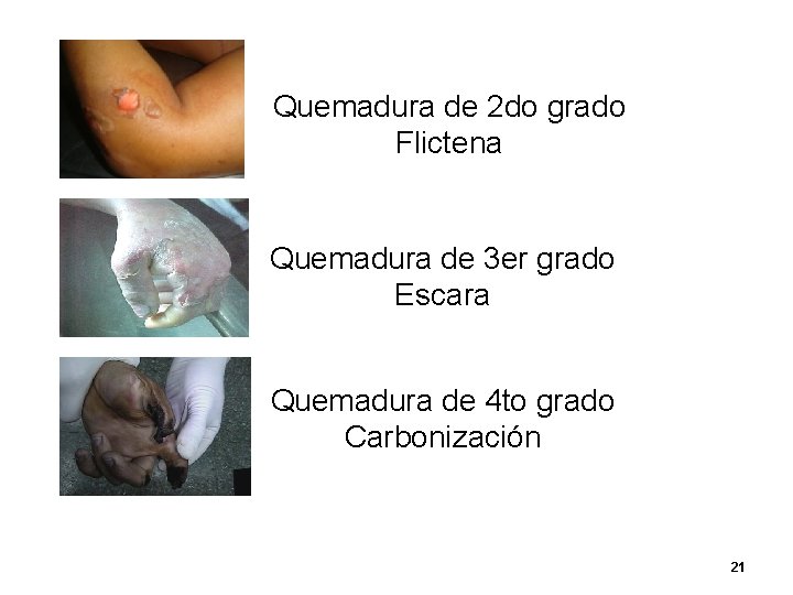 Quemadura de 2 do grado Flictena Quemadura de 3 er grado Escara Quemadura de Quemadura de 2 do grado Flictena Quemadura de 3 er grado Escara Quemadura de