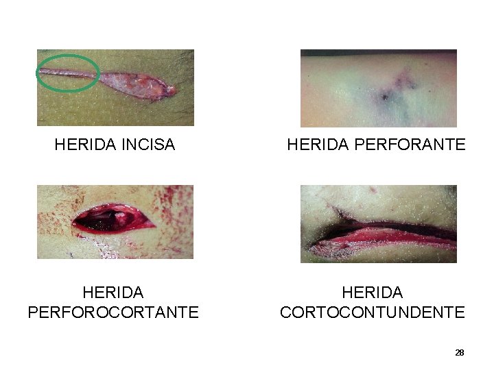 HERIDA INCISA HERIDA PERFORANTE HERIDA PERFOROCORTANTE HERIDA CORTOCONTUNDENTE 28 HERIDA INCISA HERIDA PERFORANTE HERIDA PERFOROCORTANTE HERIDA CORTOCONTUNDENTE 28
