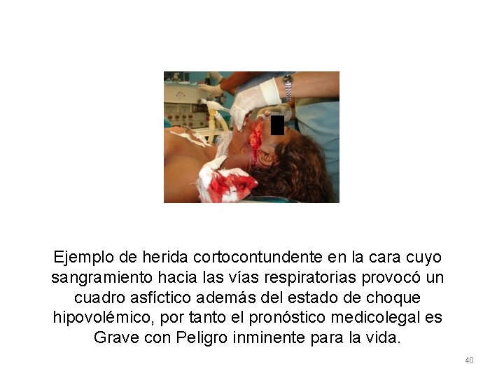Ejemplo de herida cortocontundente en la cara cuyo sangramiento hacia las vías respiratorias provocó Ejemplo de herida cortocontundente en la cara cuyo sangramiento hacia las vías respiratorias provocó