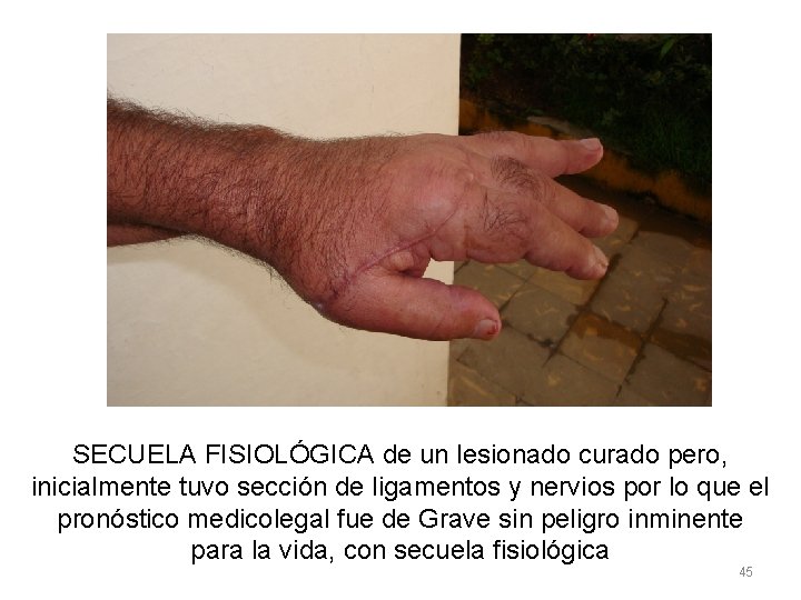 SECUELA FISIOLÓGICA de un lesionado curado pero, inicialmente tuvo sección de ligamentos y nervios SECUELA FISIOLÓGICA de un lesionado curado pero, inicialmente tuvo sección de ligamentos y nervios