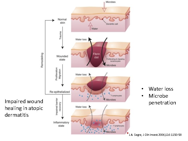 Impaired wound healing in atopic dermatitis • Water loss • Microbe penetration *J. A.