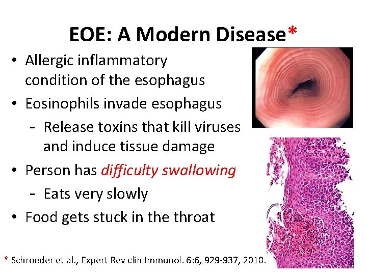 EOE: A Modern Disease* • Allergic inflammatory condition of the esophagus • Eosinophils invade