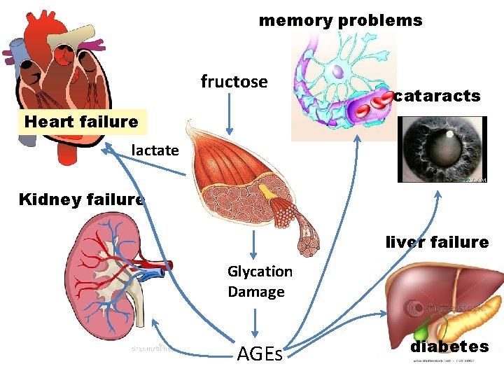 memory problems fructose cataracts Heart failure lactate Kidney failure liver failure Glycation Damage AGEs