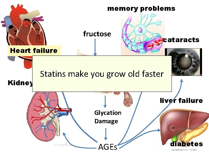 memory problems fructose cataracts Heart failure lactate Statins make you grow old faster Kidney