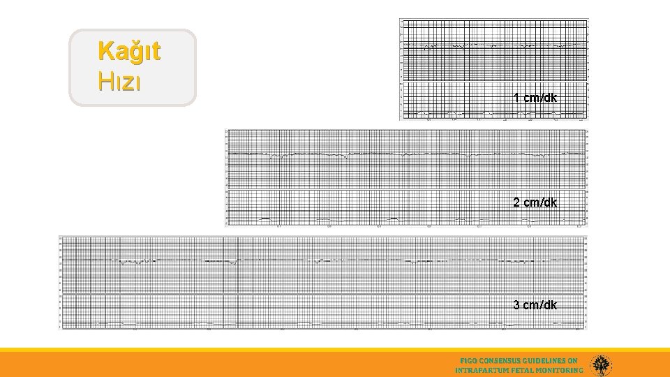 Kağıt Hızı 1 cm/dk 2 cm/dk 3 cm/dk FIGO CONSENSUS GUIDELINES ON INTRAPARTUM FETAL