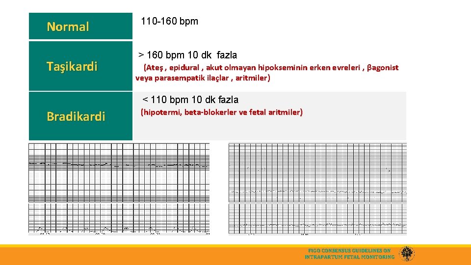 Normal Taşikardi 110 -160 bpm > 160 bpm 10 dk fazla (Ateş , epidural