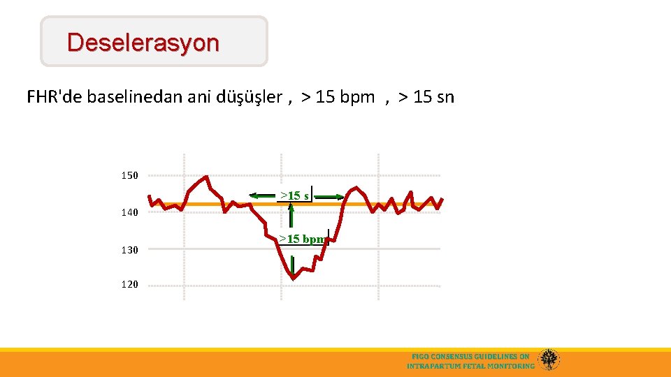 Deselerasyon FHR'de baselinedan ani düşüşler , > 15 bpm , > 15 sn 150