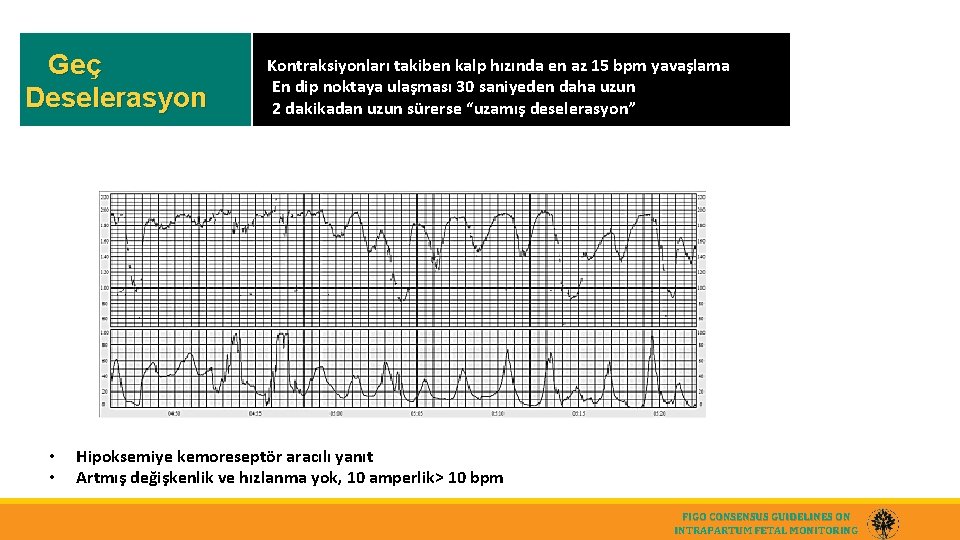 Geç Deselerasyon • • Kontraksiyonları takiben kalp hızında en az 15 bpm yavaşlama En