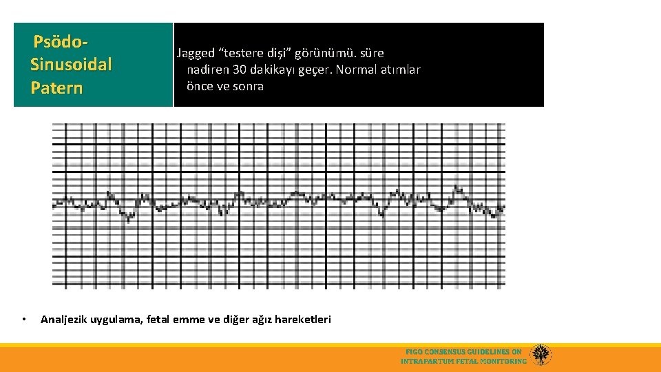 Psödo. Pseudo-sinusoidal pattern Jagged “testere dişi” görünümü. süre Sinusoidal nadiren 30 dakikayı geçer. Normal