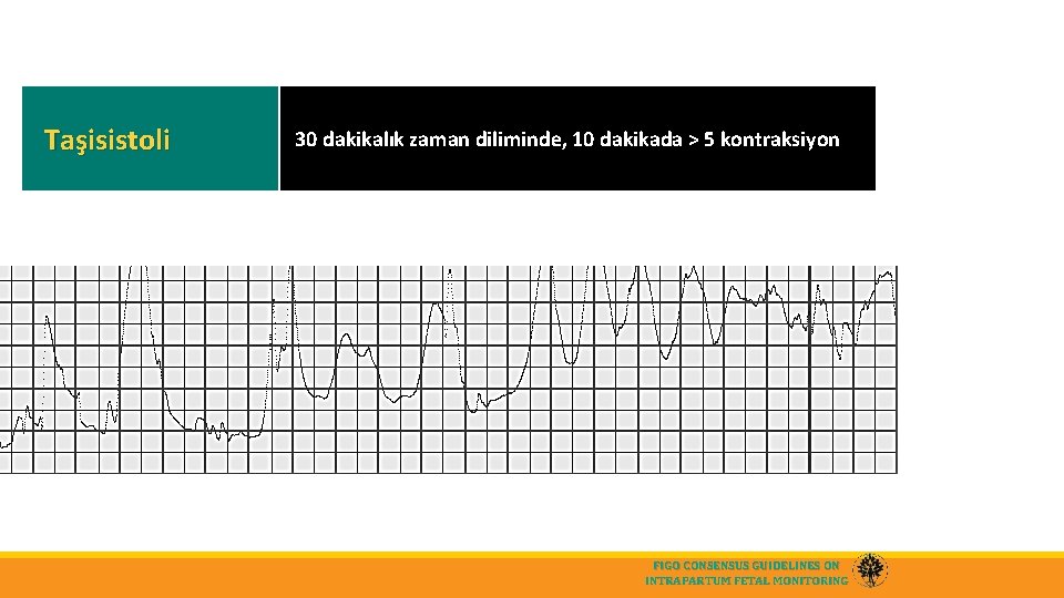 Taşisistoli 30 dakikalık zaman diliminde, 10 dakikada > 5 kontraksiyon FIGO CONSENSUS GUIDELINES ON