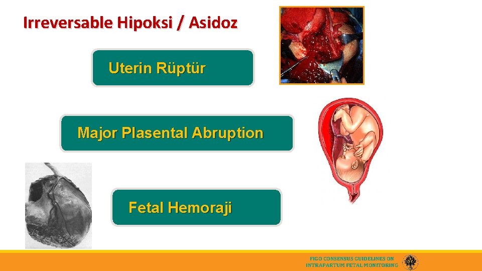 Irreversable Hipoksi / Asidoz Uterin Rüptür Major Plasental Abruption Fetal Hemoraji FIGO CONSENSUS GUIDELINES