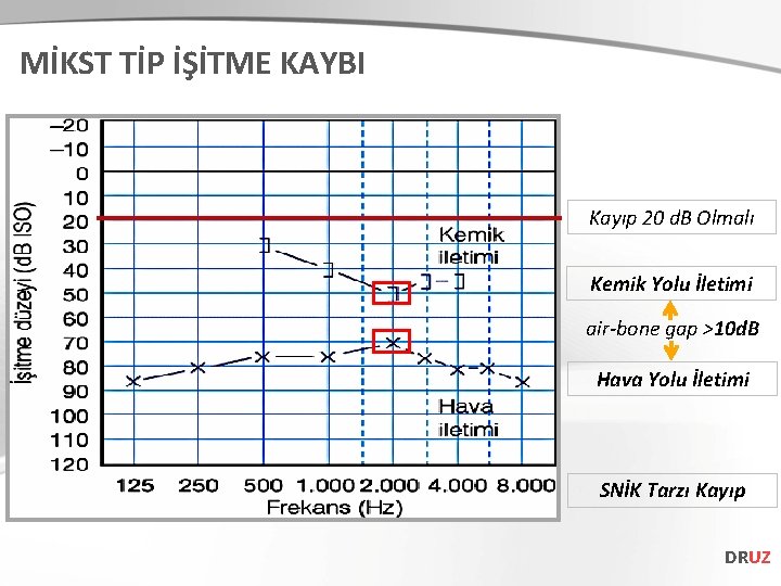 MİKST TİP İŞİTME KAYBI Kayıp 20 d. B Olmalı Kemik Yolu İletimi air-bone gap