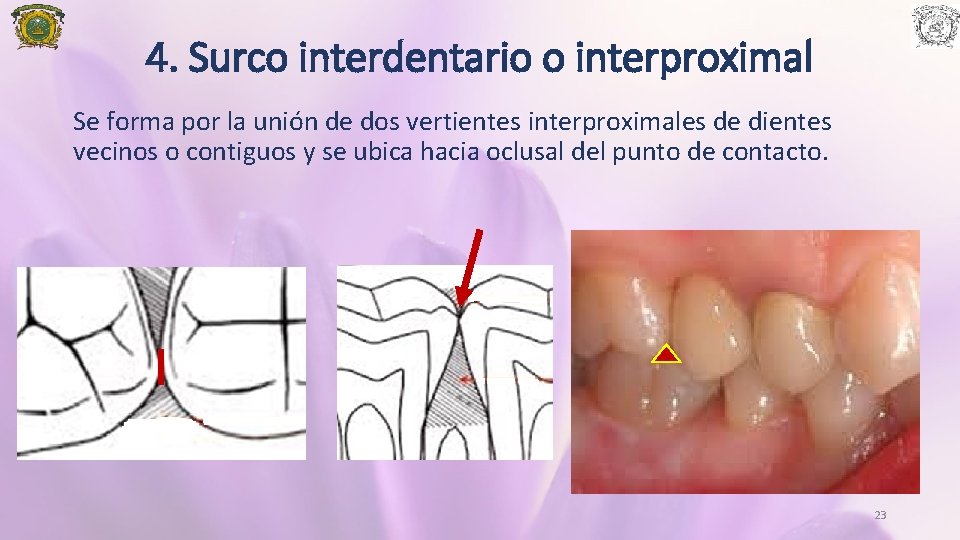 4. Surco interdentario o interproximal Se forma por la unión de dos vertientes interproximales