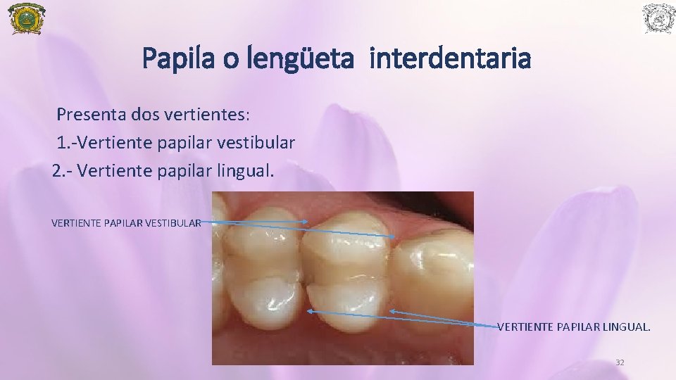 Papila o lengüeta interdentaria Presenta dos vertientes: 1. -Vertiente papilar vestibular 2. - Vertiente