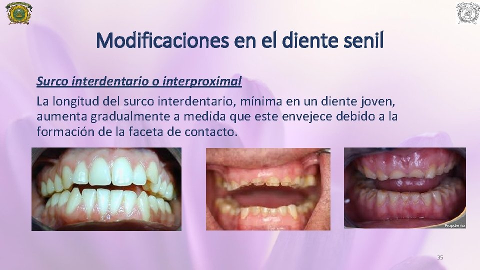 Modificaciones en el diente senil Surco interdentario o interproximal La longitud del surco interdentario,